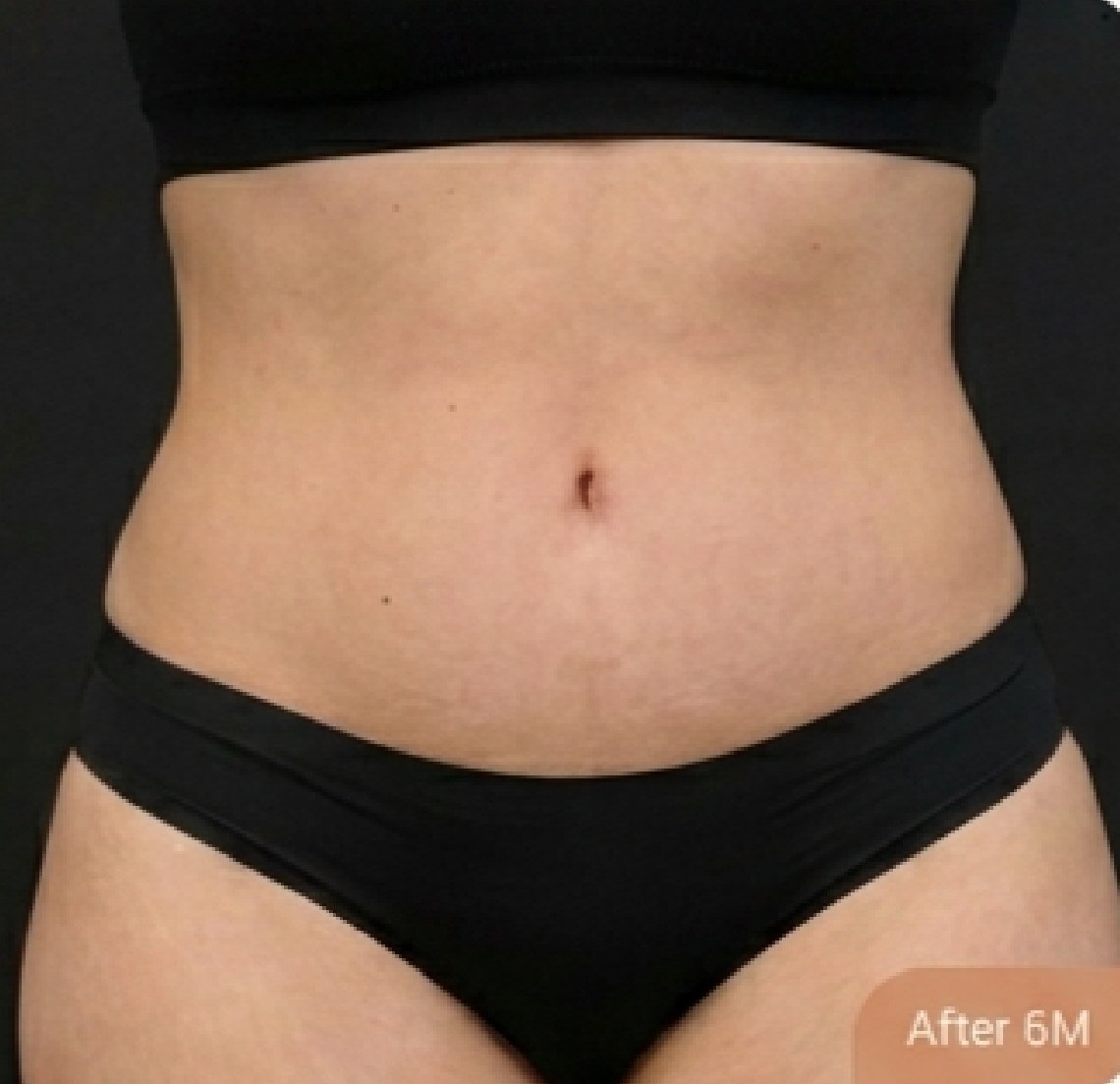 Tummy tuck (abdominoplasty) — after (Front view · 6 months post-op)