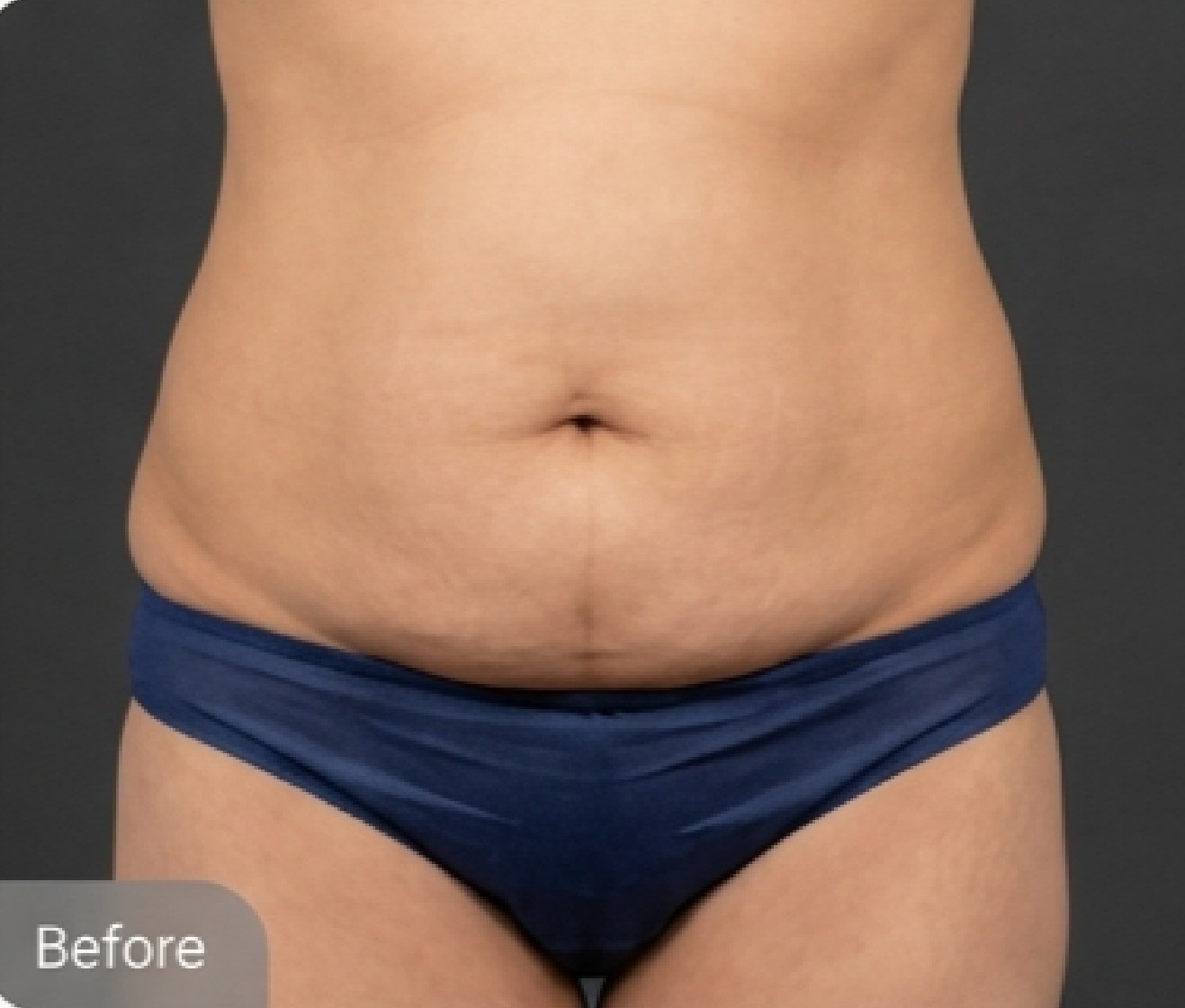 Tummy tuck (abdominoplasty) — before (Front view · 6 months post-op)