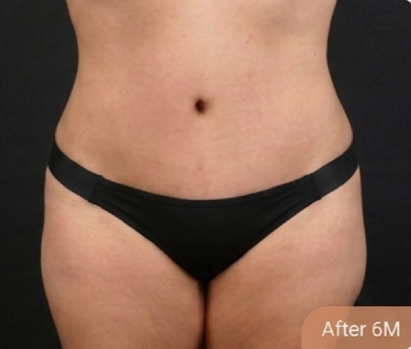 Tummy tuck (abdominoplasty) — after (Front view · 6 months post-op)